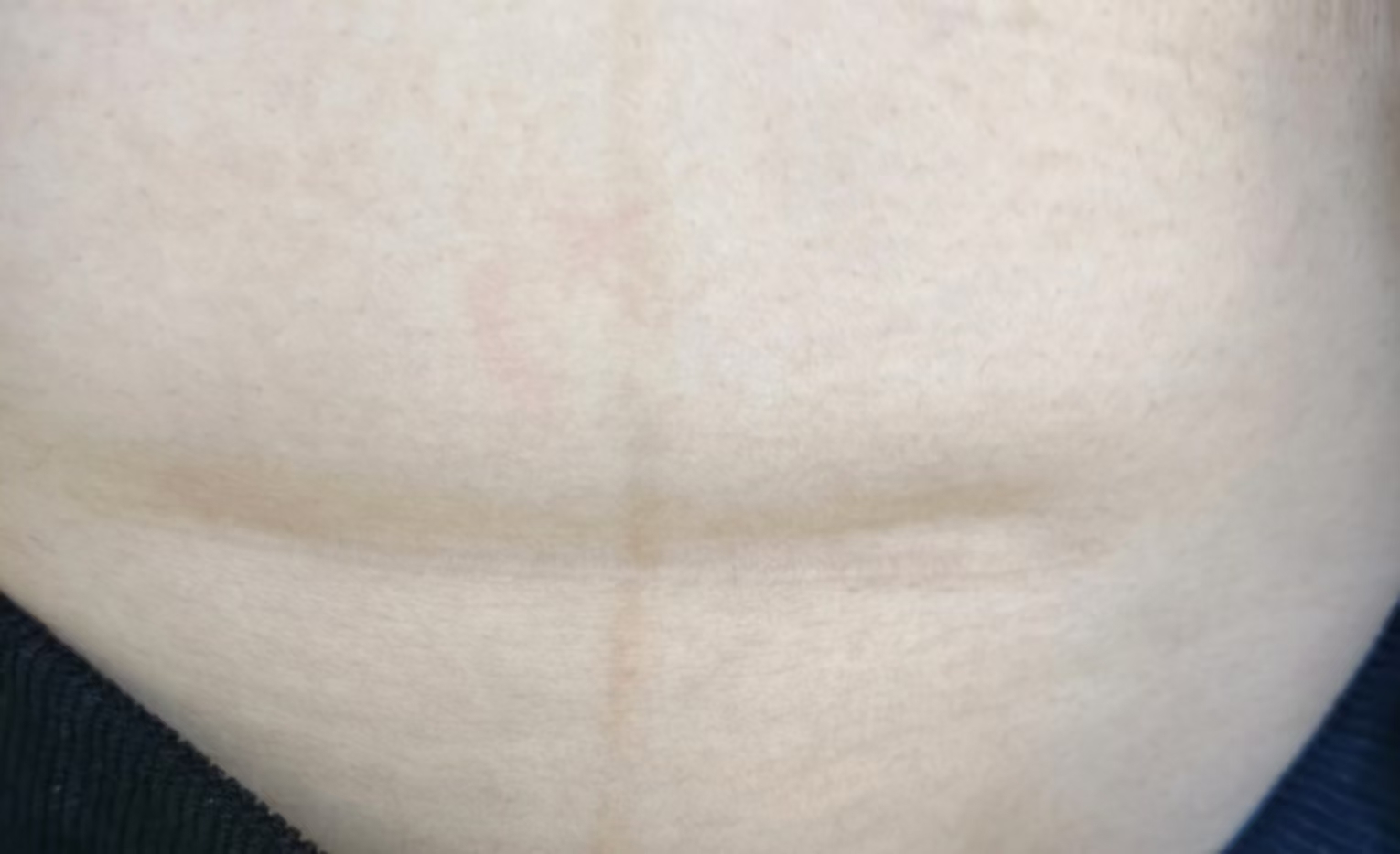 剖腹产疤痕护理经验分享