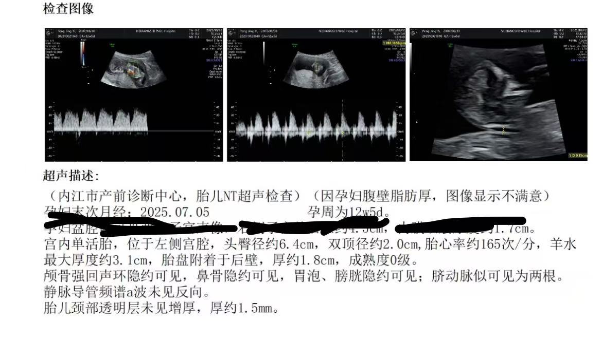 孕期乳房胀痛与分泌物的困扰