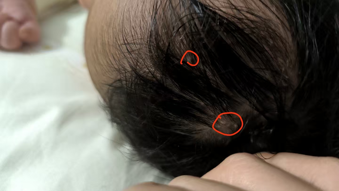 宝宝头上长小痘痘怎么办