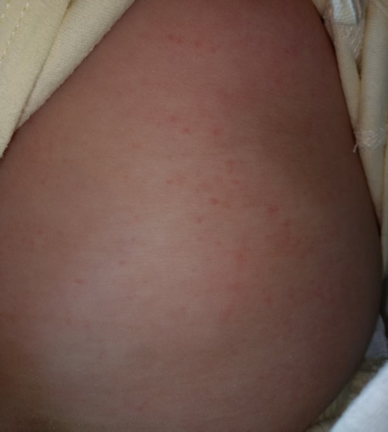 宝宝热疹怎么办？