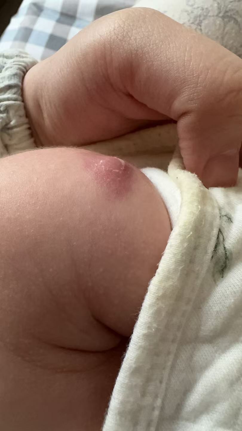 新生儿疫苗反应观察记