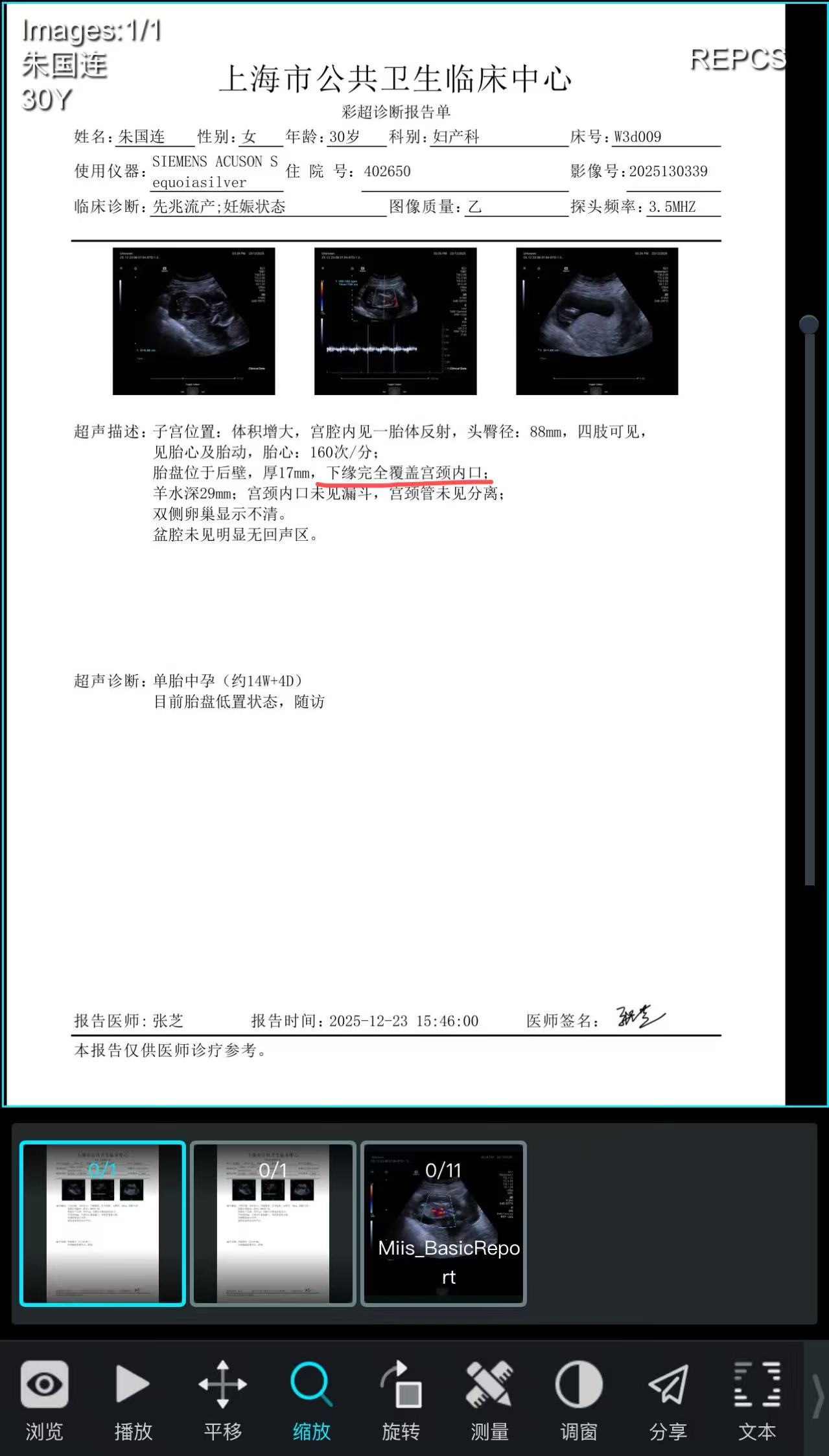 孕期胎盘完全覆盖宫颈的担忧