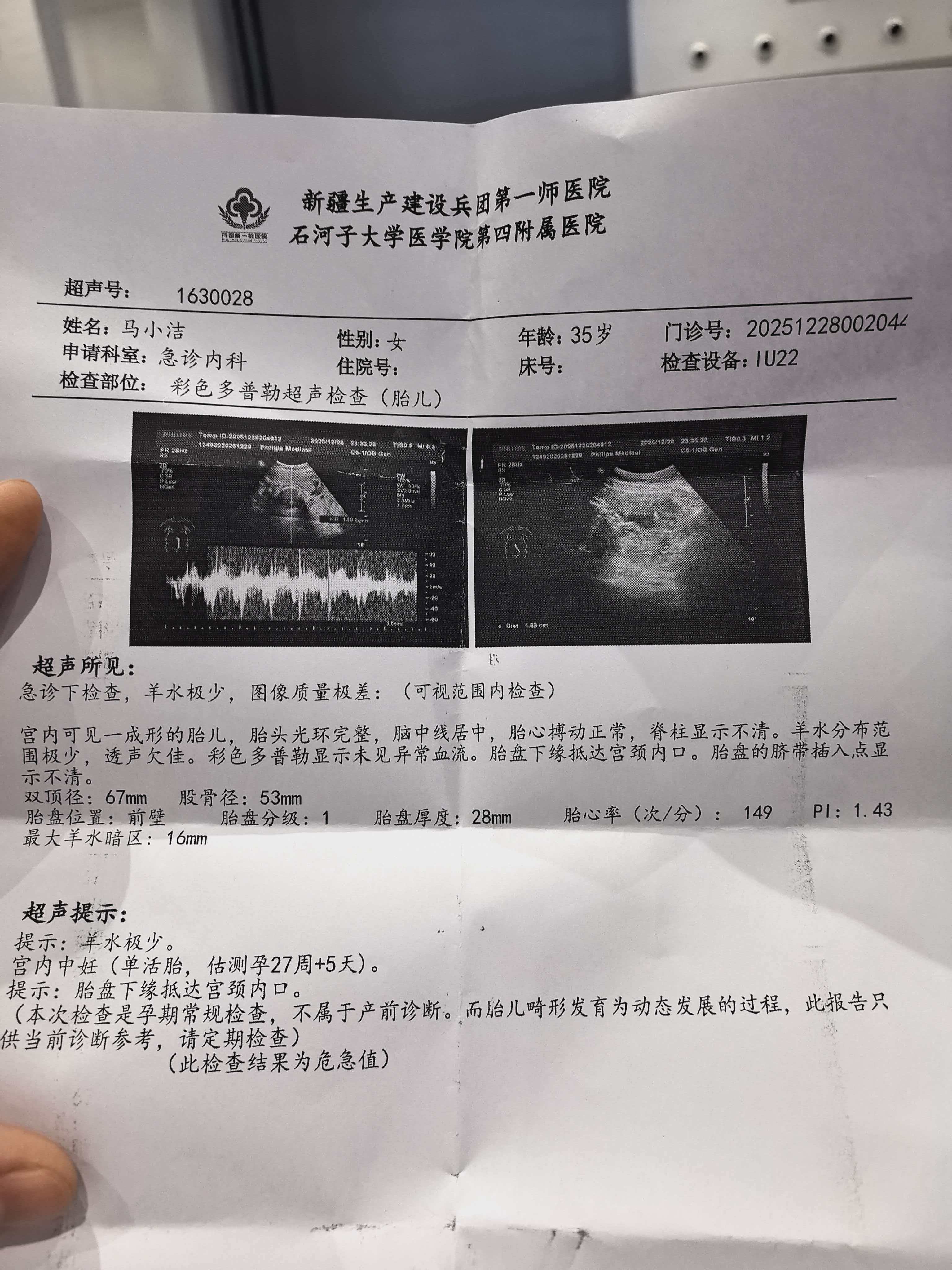 孕晚期羊水突然减少的紧急经历